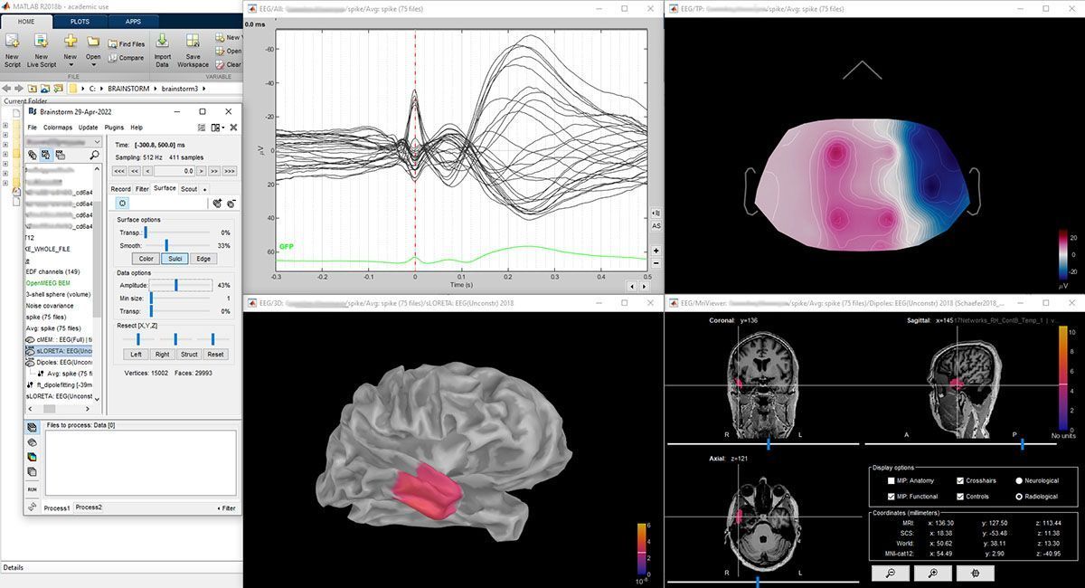 Brainstorm.-Estacion-de-trabajo-con-imяgenes-de-CASO-11 Qué es la Cirugía de Epilepsia