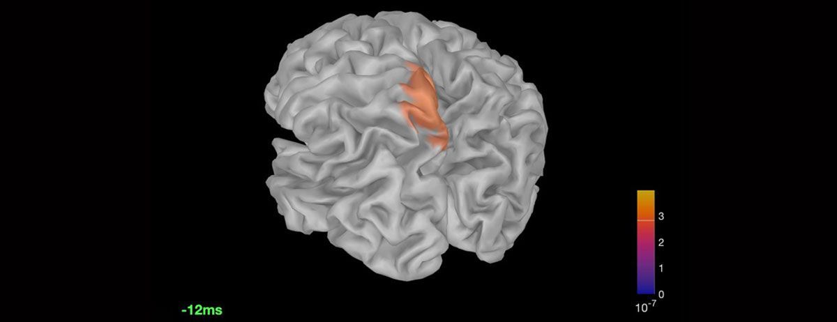 ESI_1-1 Qué es la Cirugía de Epilepsia