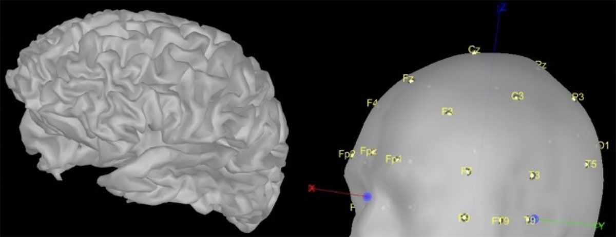 ESI_2-1 Qué es la Cirugía de Epilepsia