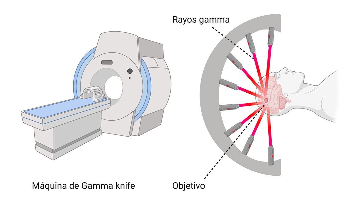 GammaKnife Técnicas de Cirugía