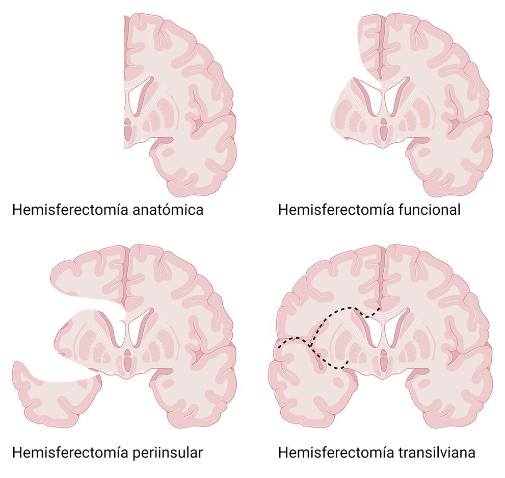Hemisferectom­a-1 Técnicas de Cirugía