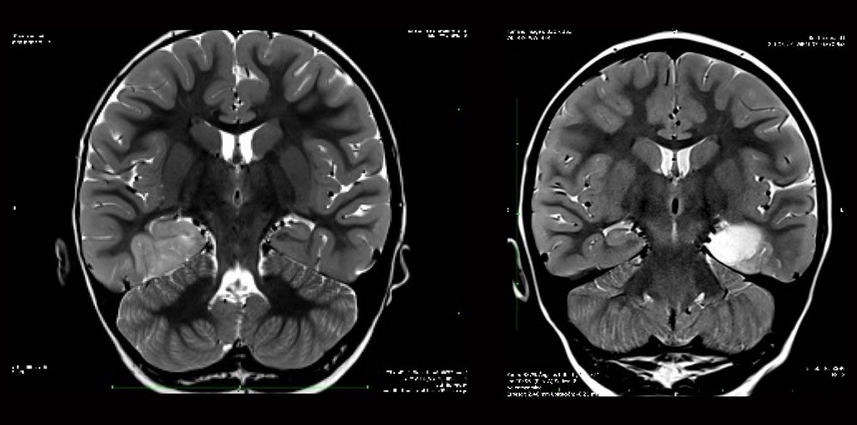 Imagen-del-cerebro-antes-y-despues-de-la-intervencion Técnicas de Cirugía