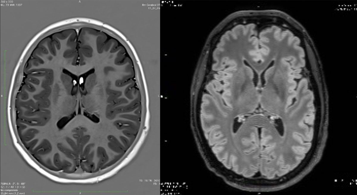 Imagenes-de-plano-axial Qué es la Cirugía de Epilepsia