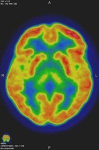 Resonancia-e1702485786797 Qué es la Cirugía de Epilepsia
