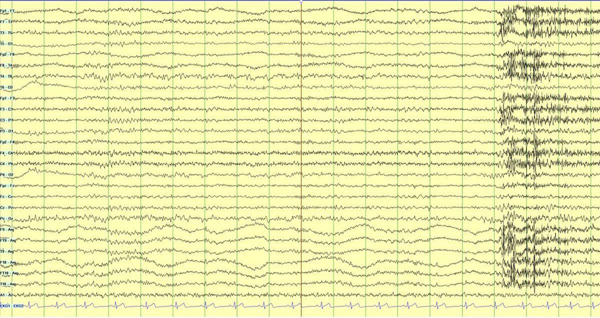 SEEG.-Crisis-epil‚ptica.-Con-c-mara-difuminada.-CASO-3_-1 Qué es la Cirugía de Epilepsia