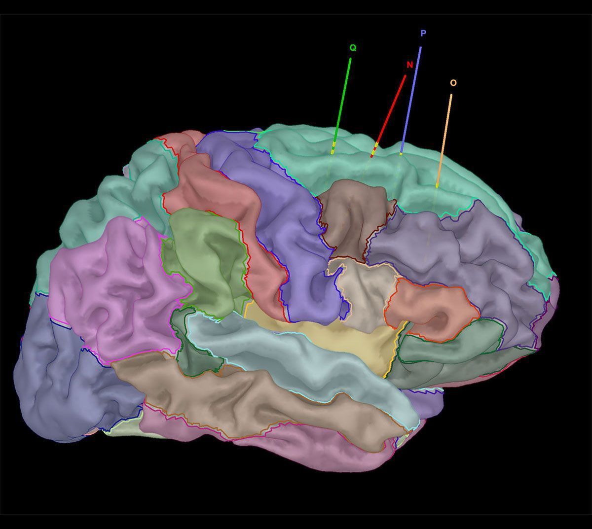 SEEG.-Implantacion-electrodos-en-3D-con-reas-en-Brainstorm.-CASO-4.-2-1 Técnicas de Cirugía