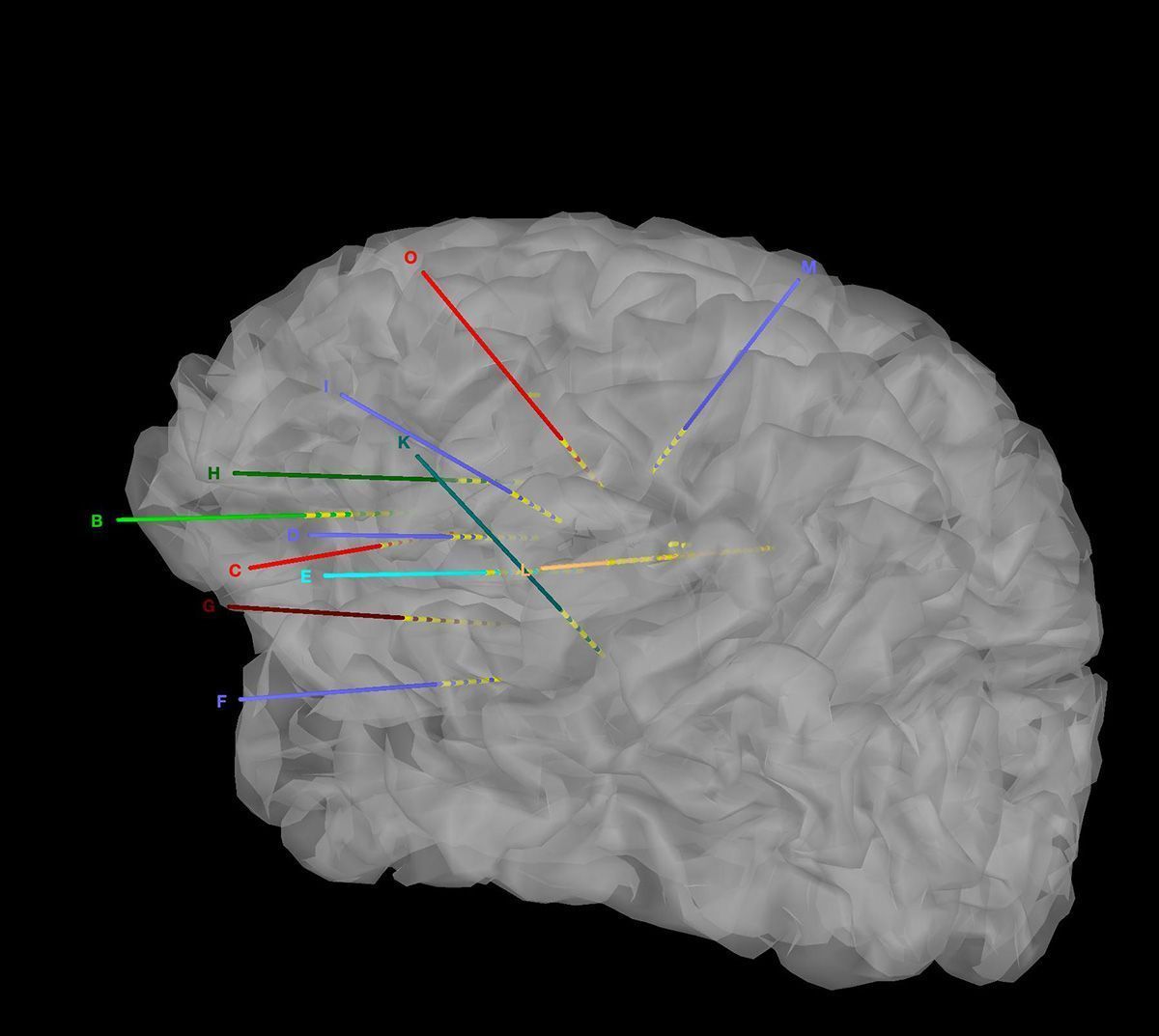 SEEG.-Implantaciขn-electrodos-en-3D-en-Brainstorm.-CASO-5_ Técnicas de Cirugía